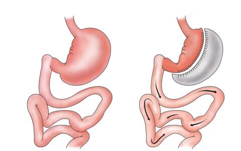 袖状胃手术：“切胃减肥”暗藏的玄机，或许只有内行人才能看懂